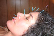 Acupuncture Needle