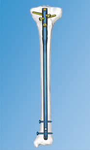 Titanium Cannulated Tibial Nail EX in 44-Sector, Gurgaon | Synthes